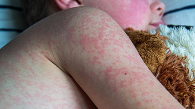 Waspada.! Campak Mewabah di Lampung Utara